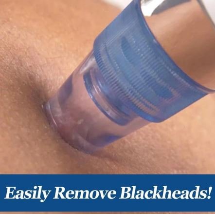 4-in-1 Electric Blackhead Remover Vacuum Suction Acne & Pore Cleaner Device - Image 3